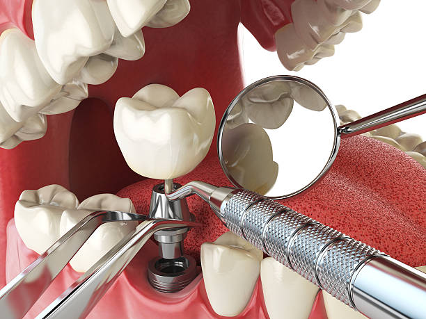 Best Emergency Tooth Extraction in Quantico Base, VA